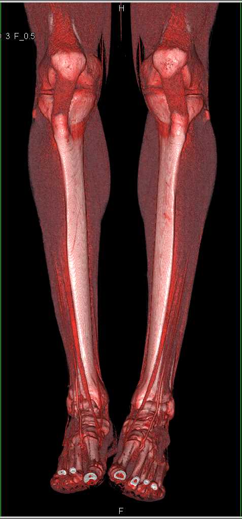 CTA with Mild Peripheral Vascular Disease - CTisus CT Scan