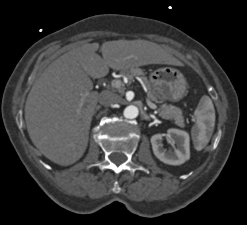 FMD (Fibromuscular Dysplasia) Involves the Renal Arteries and the Superior Mesenteric Artery (SMA) - CTisus CT Scan