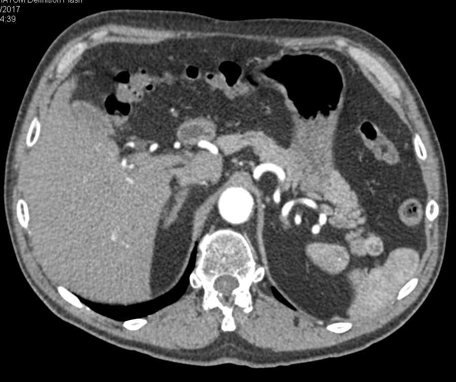 Left Renal Artery Aneurysm - CTisus CT Scan