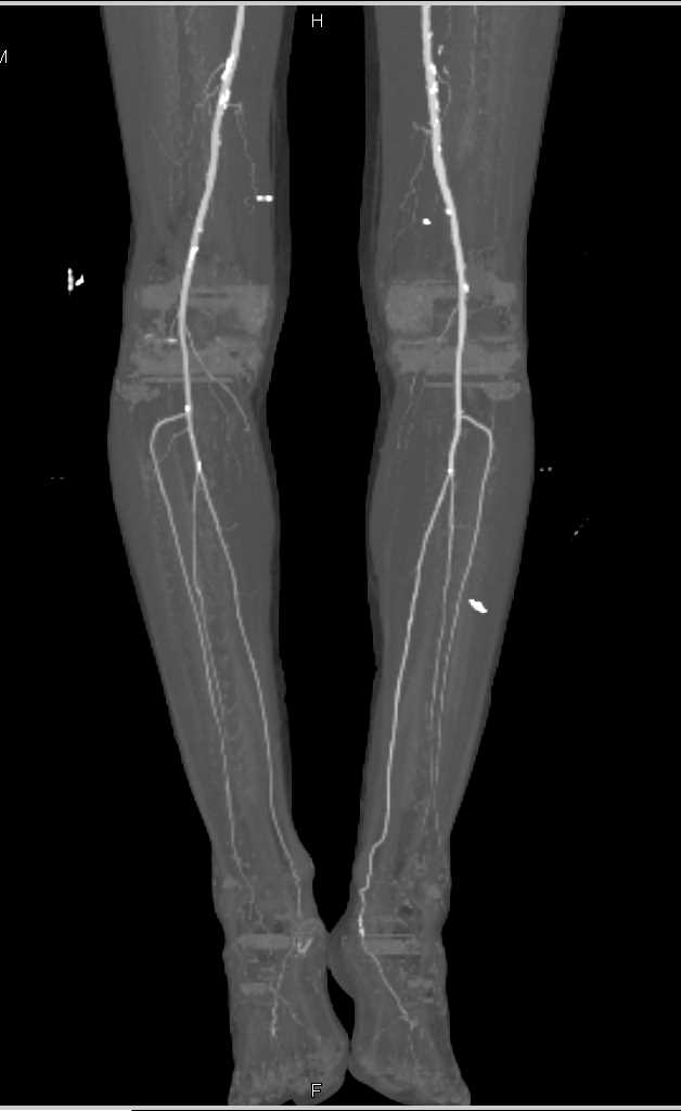 Peripheral Vascular Disease - CTisus CT Scan