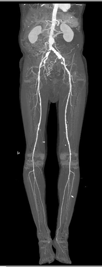 Abdominal Aortic Aneurysm and Significant Iliac Vascular Disease - CTisus CT Scan