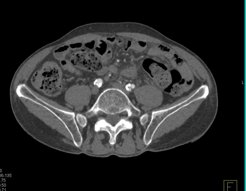 Peripheral Vascular Disease - CTisus CT Scan