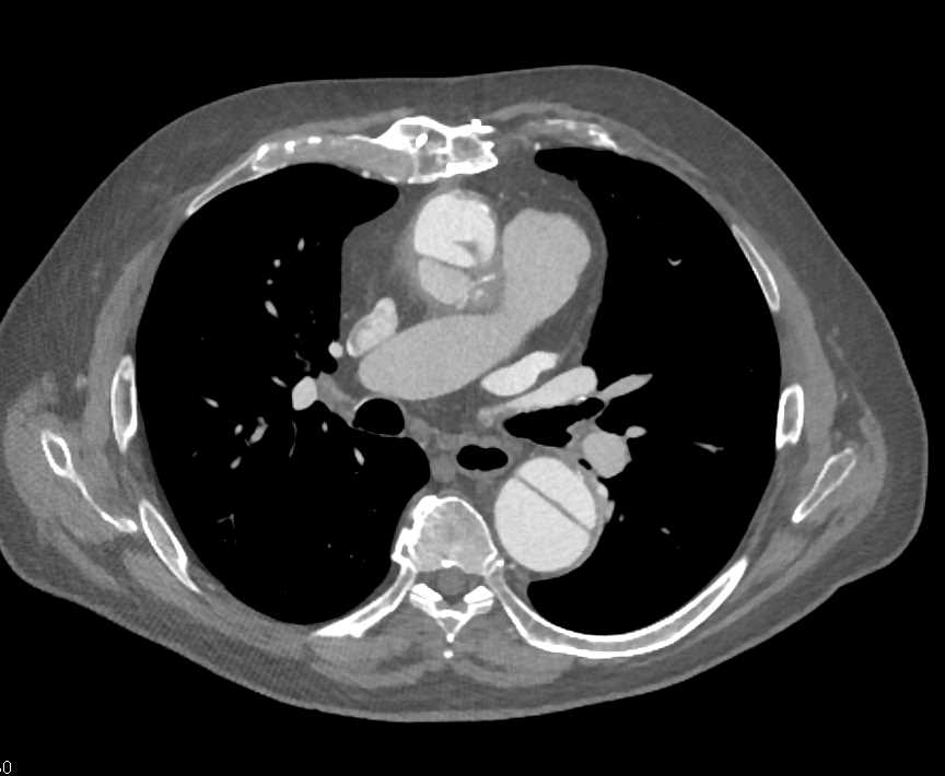 Type A Dissection with Repair - CTisus CT Scan