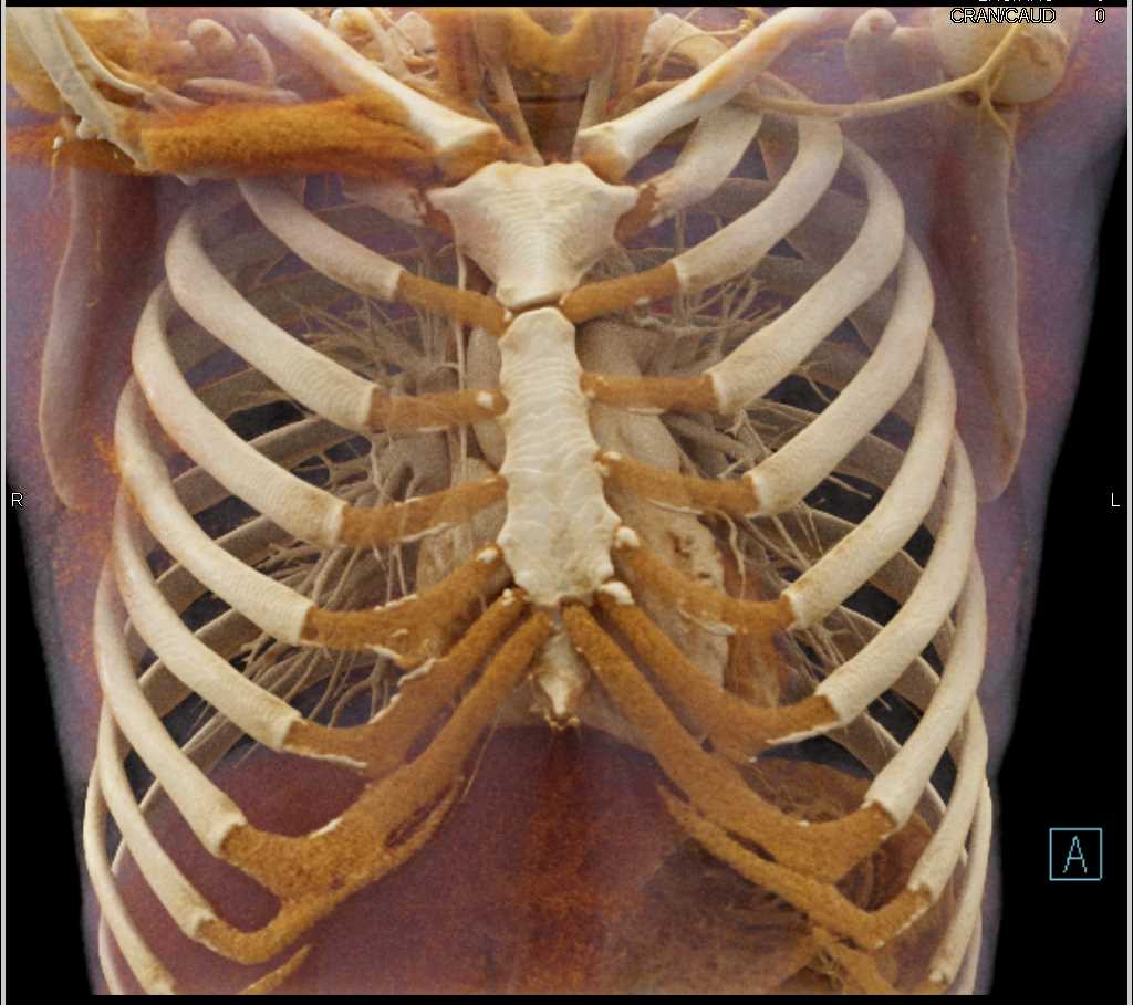 Stent in Distal Aortic Arch Using Cinematic Rendering - CTisus CT Scan