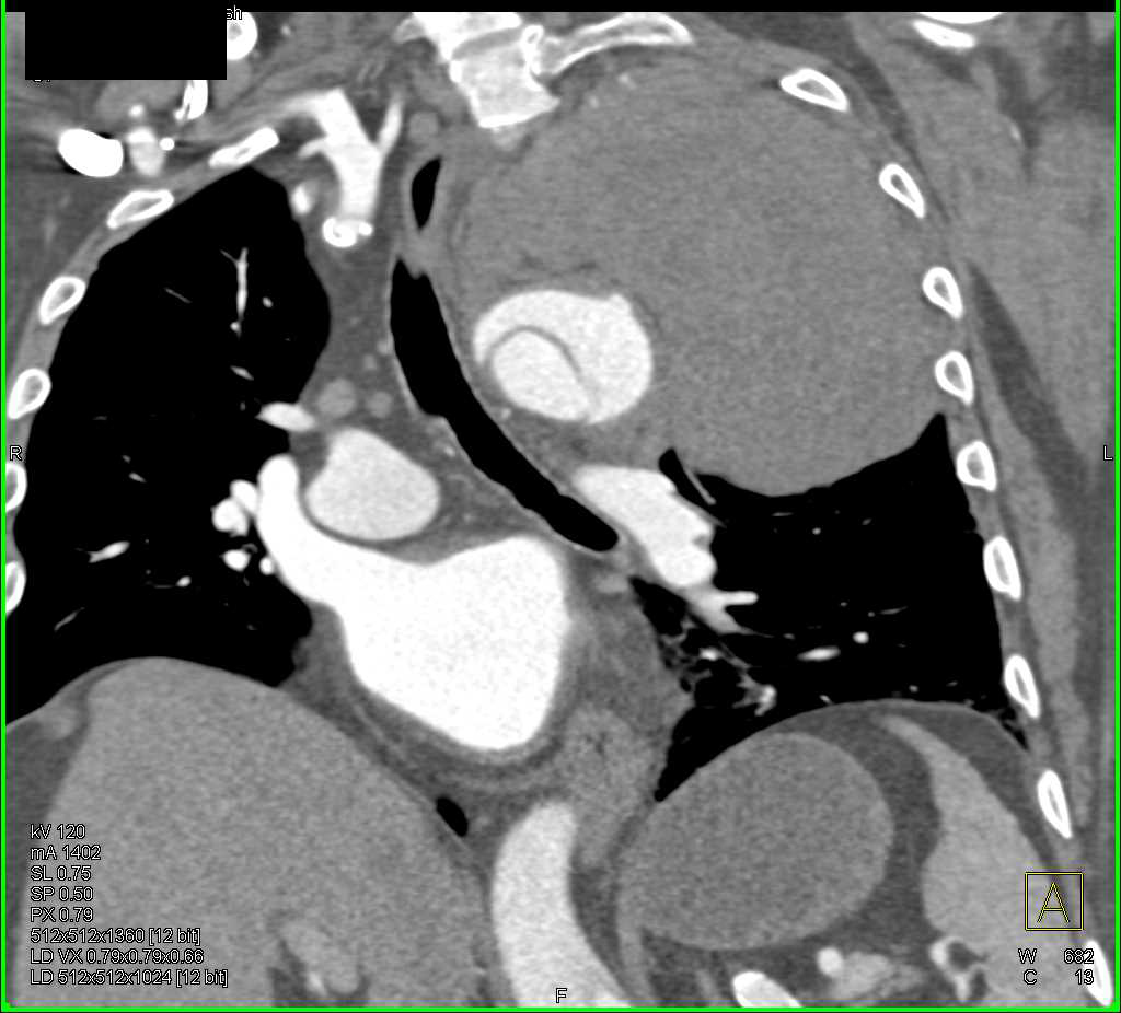 Type A Dissection - CTisus CT Scan