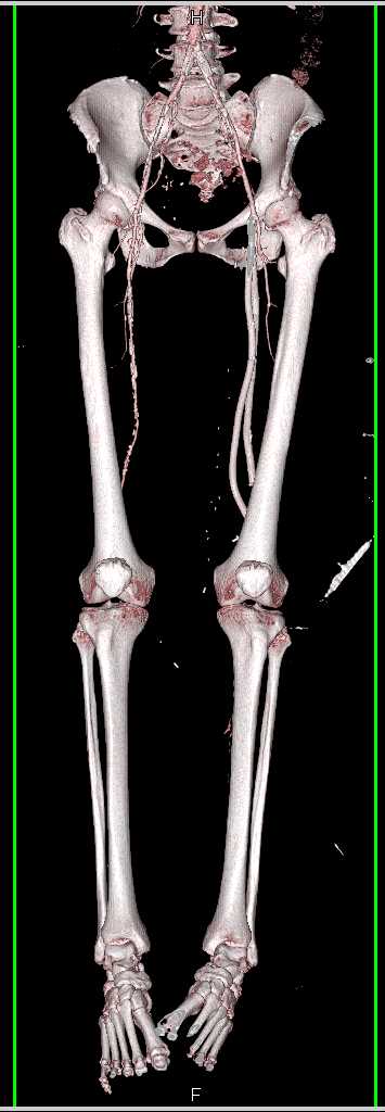 Left Superficial Femoral Artery (SFA)-Popliteal Artery Graft - CTisus CT Scan