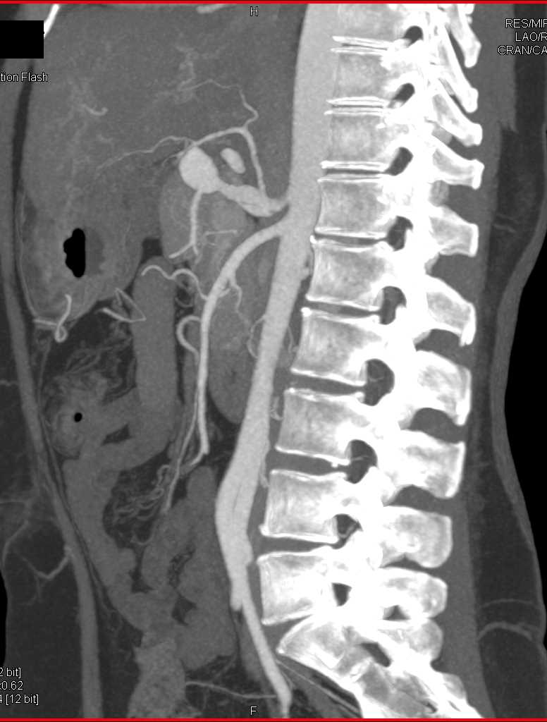 Hepatic Artery Aneurysm - CTisus CT Scan