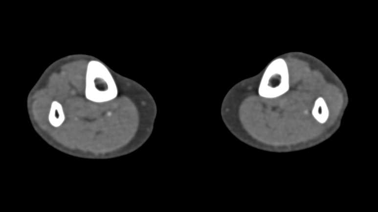 CTA Runoff with Peripheral Vascular Disease (PVD) - CTisus CT Scan