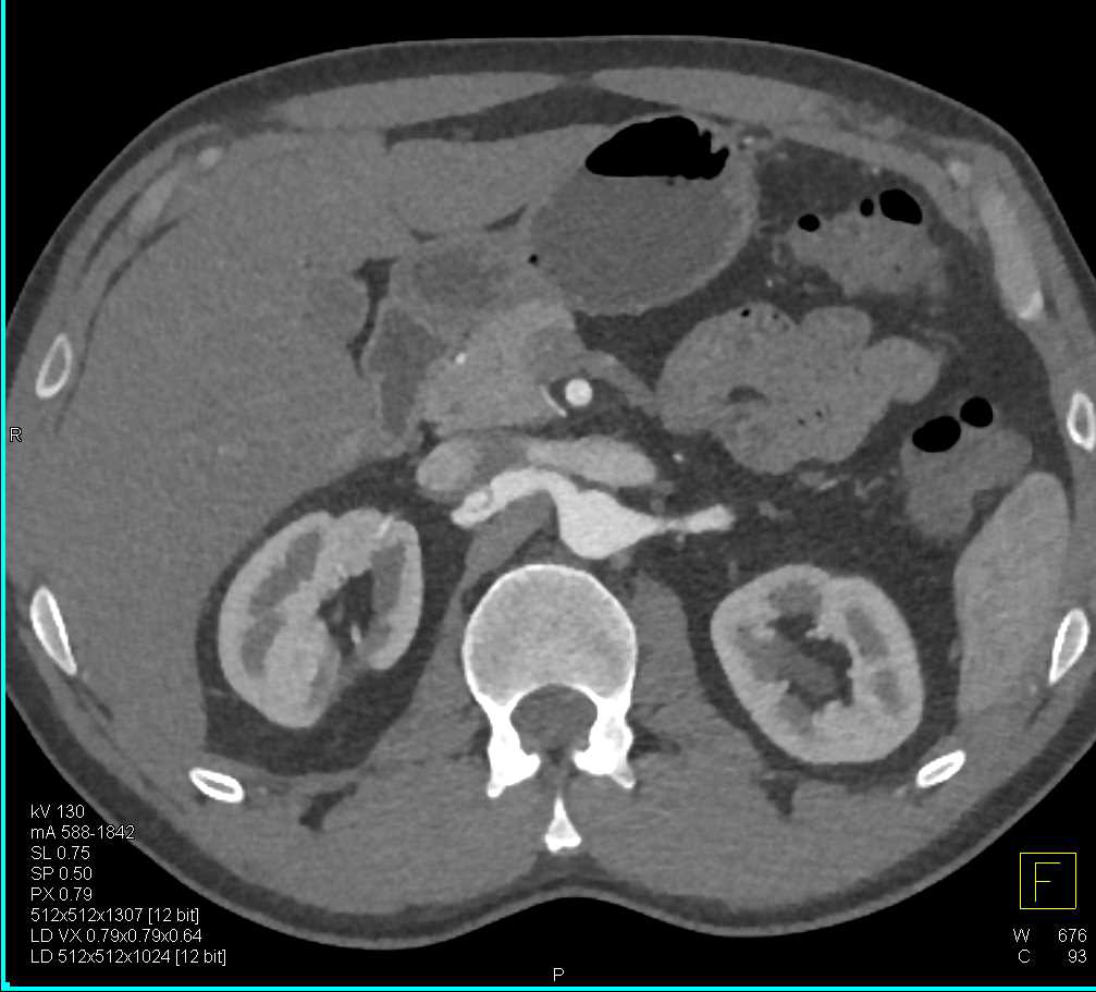 Aortic Aneurysm and Dissection in the Right Renal Artery - CTisus CT Scan