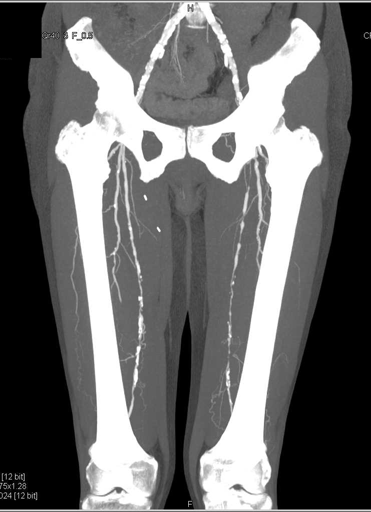 Peripheral Vascular Disease - CTisus CT Scan