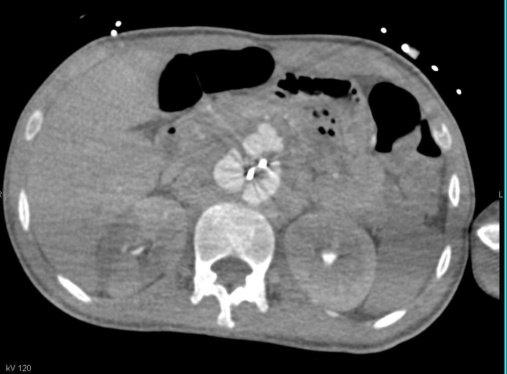 Aortic Aneurysm with Stent and Right Renal Infarcts - CTisus CT Scan