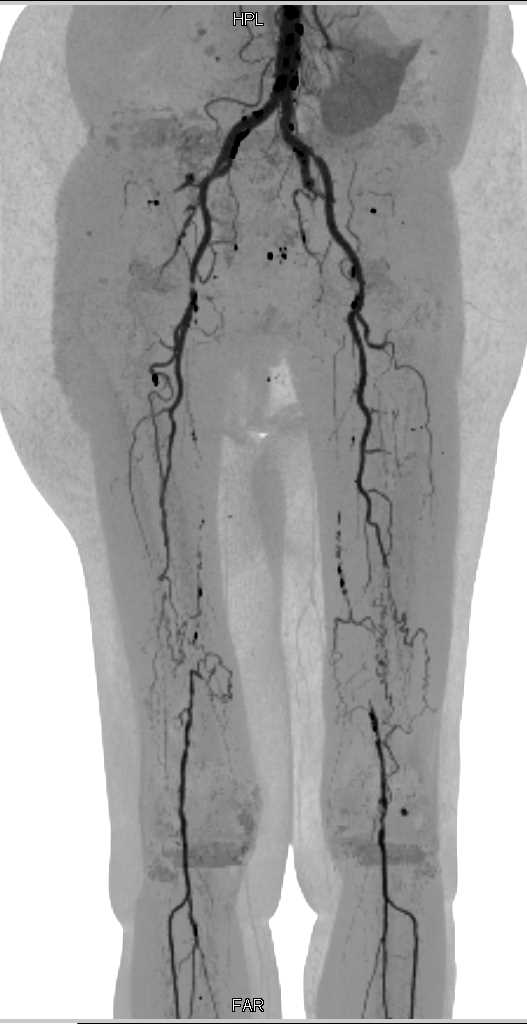 Extensive Peripheral Arterial Disease (PAD) with Occlusion of the Superficial Femoral Arteries (SFAs) Bilaterally and Incidental Right Renal Angiomyolipoma (AML) - CTisus CT Scan