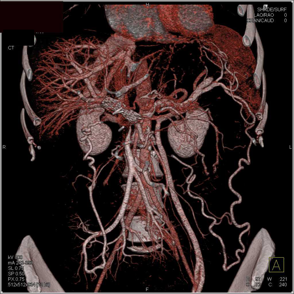 Stent in the Portal Vein - CTisus CT Scan