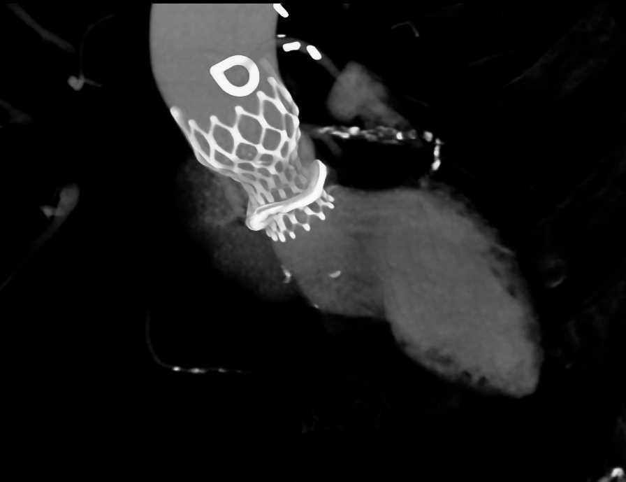 Endovascular Stent Repair Aortic Root and Ascending Aorta - CTisus CT Scan