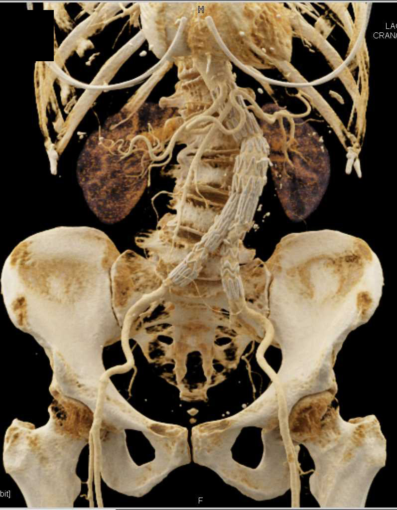 Endovascular Stent Abdominal Aorta with Cinematic Rendering - CTisus CT Scan