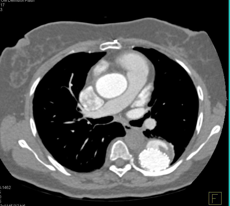 Type 3 Endoleak Thoracic Aorta with Endovascular Stent - CTisus CT Scan