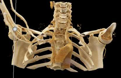 Vascular Mapping for Thoracic Syndrome with Cinematic Rendering - CTisus CT Scan