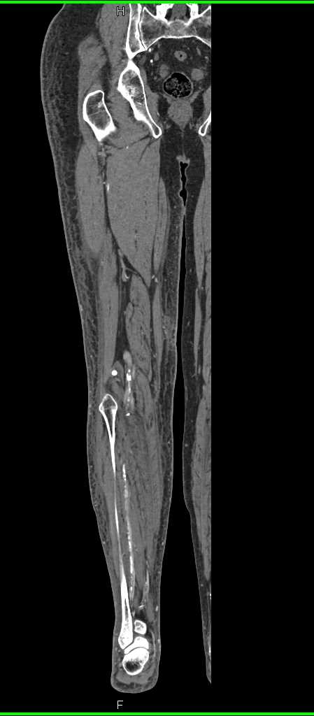 CTA with Extensive Peripheral Vascular Disease - CTisus CT Scan