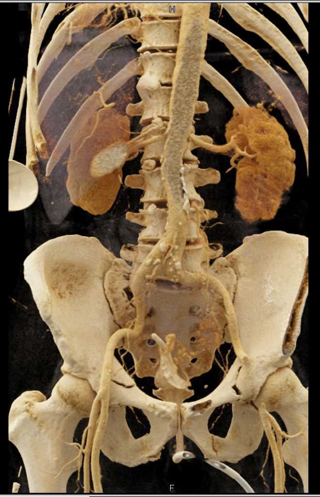 Cinematic Rendering of the Pelvis and Vasculature - CTisus CT Scan