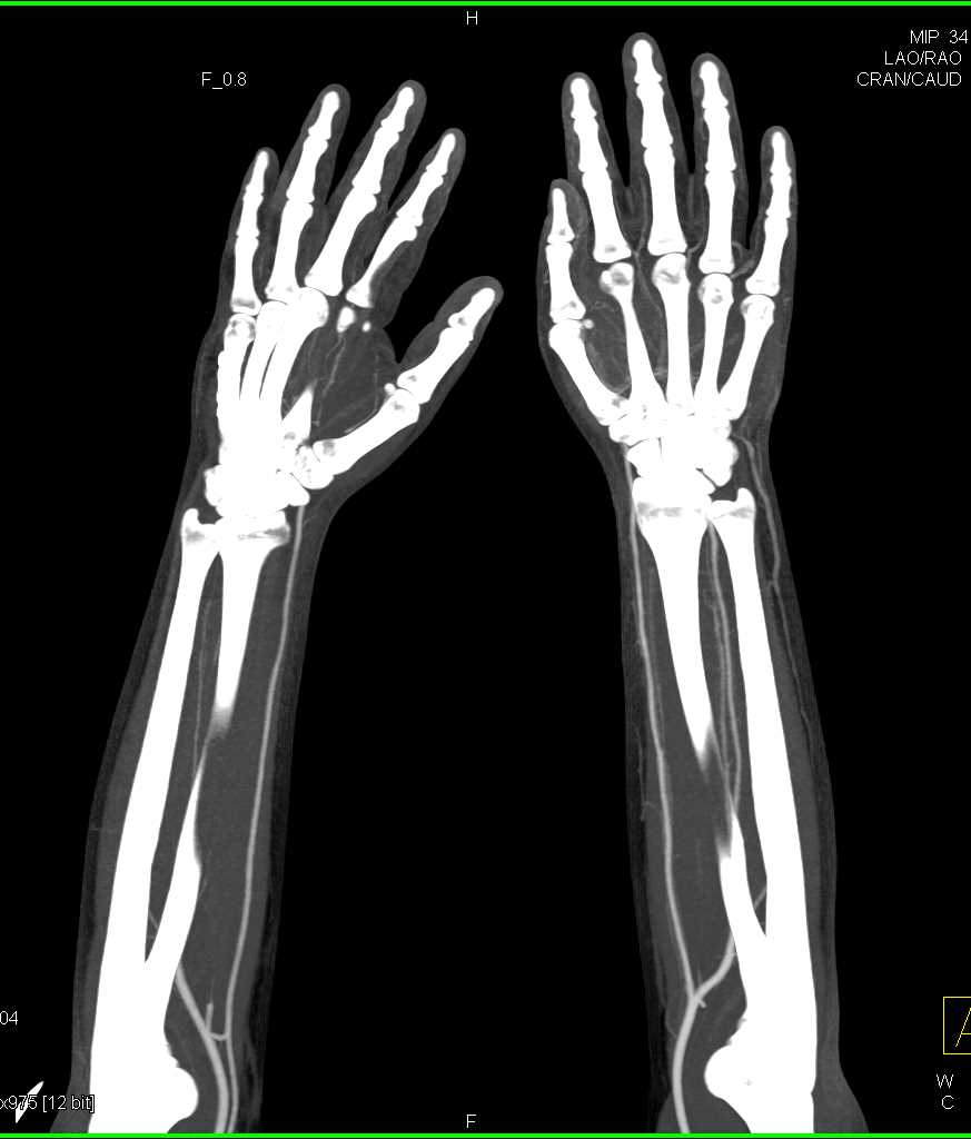 CT Mapping of the Radial and Ulnar Arteries - CTisus CT Scan