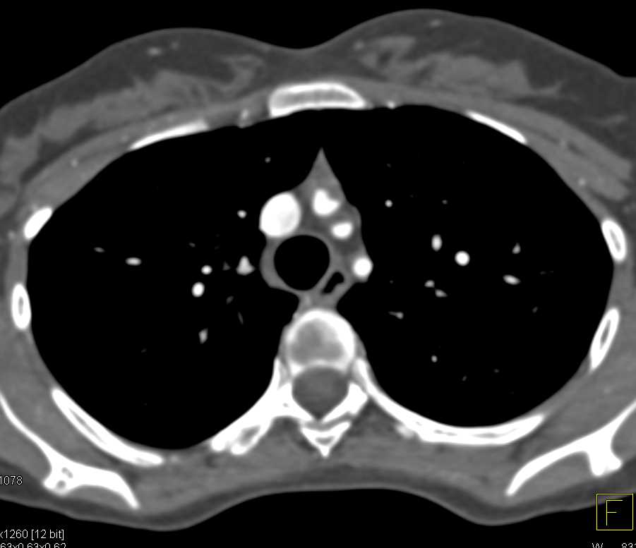 Superior Mesenteric Artery (SMA) Syndrome - CTisus CT Scan