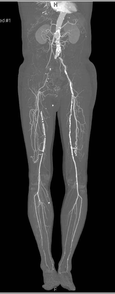 Peripheral Vascular Disease (PVD) with Vessel Segmentation - CTisus CT Scan