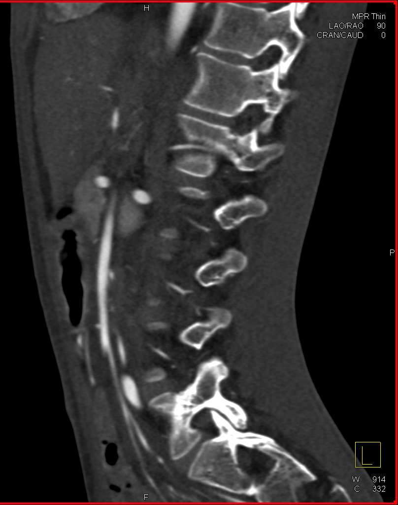 Superior Mesenteric Artery (SMA) Syndrome - CTisus CT Scan
