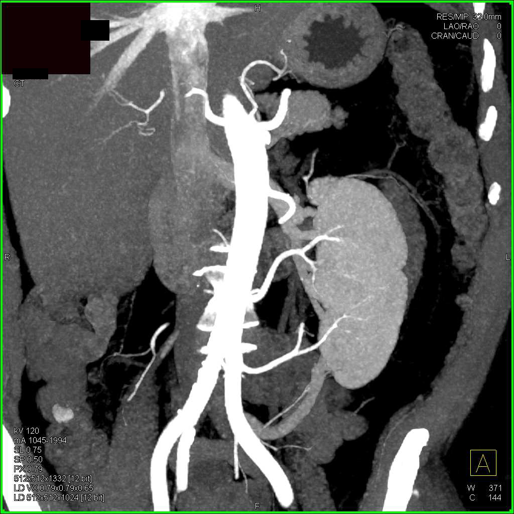 Two Renal Arteries to the Left Kidney - CTisus CT Scan
