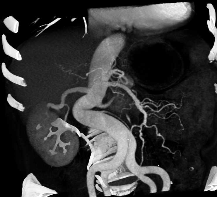 Vasculitis Superior Mesenteric Artery (SMA) - CTisus CT Scan