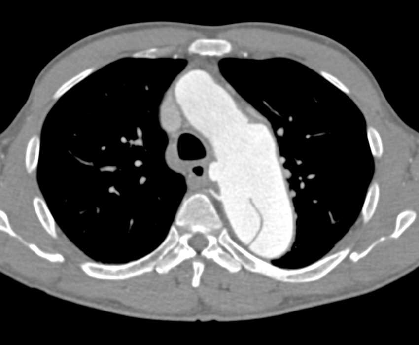 Aortic Dissection and Ulceration - CTisus CT Scan