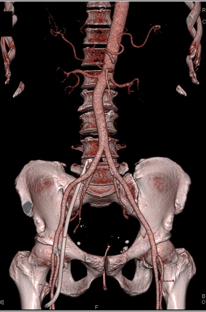 Stent in Femoral Vein - CTisus CT Scan