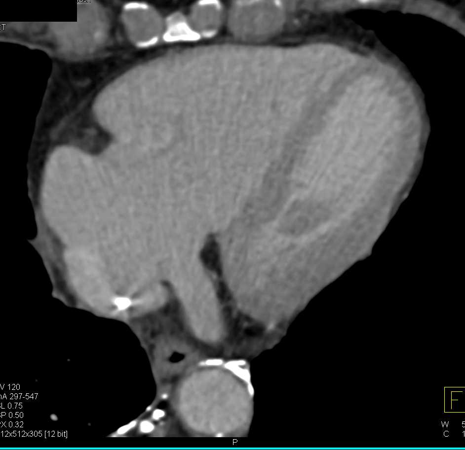 Calcified Ductus Arteriosus - CTisus CT Scan
