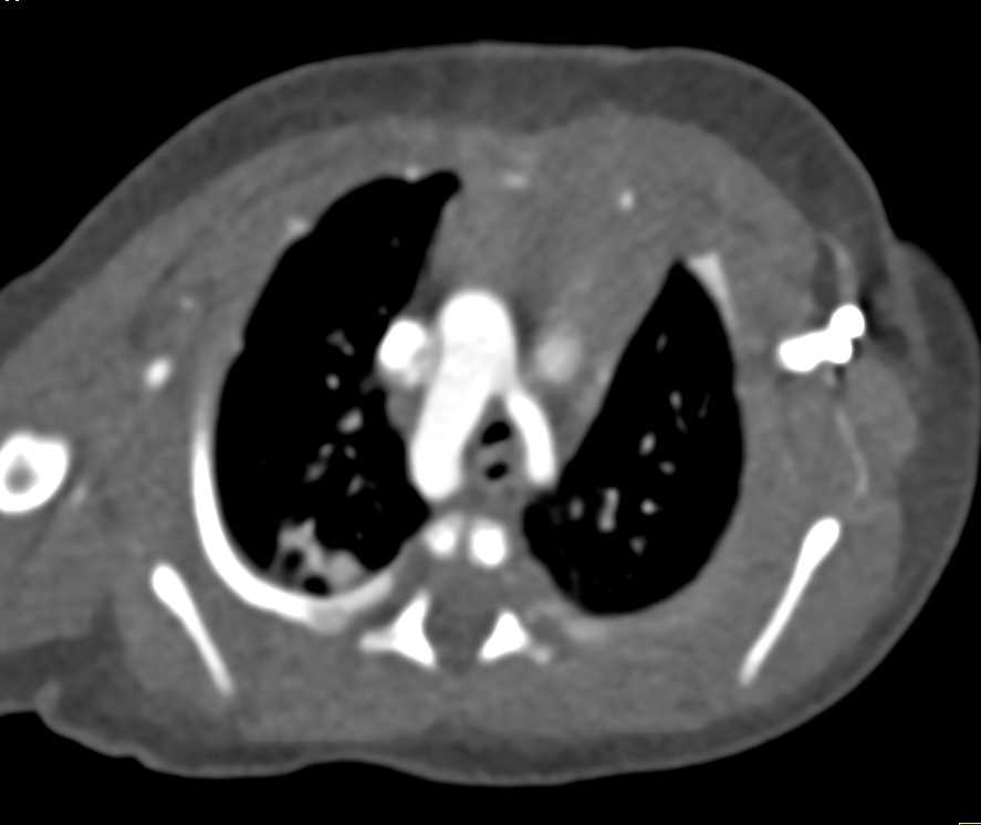 Aortic Ring with Vascular Map - CTisus CT Scan