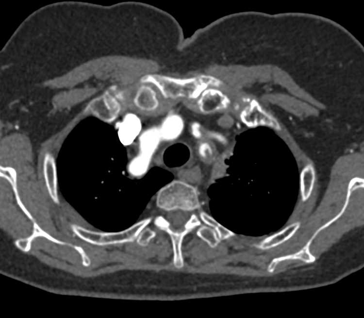 Occlusion Left Subclavian Artery - CTisus CT Scan
