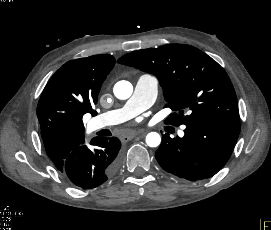 Clot in Superior Vena Cava (SVC) and Right Atrium Along Vascular Stent - CTisus CT Scan