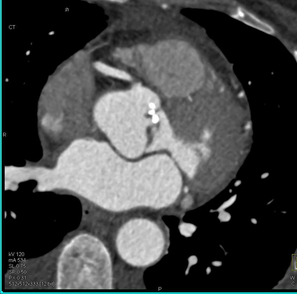 Superior Mesenteric Artery (SMA) Occlusion and Renal Infarction with Coronary Artery Disease (CAD) - CTisus CT Scan