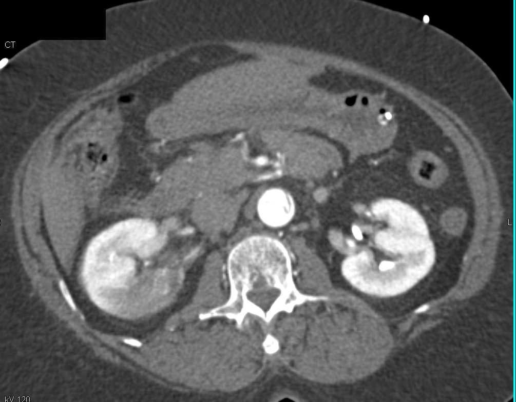 Superior Mesenteric Artery (SMA) Occlusion and Renal Infarction with Aortic Dissection - CTisus CT Scan