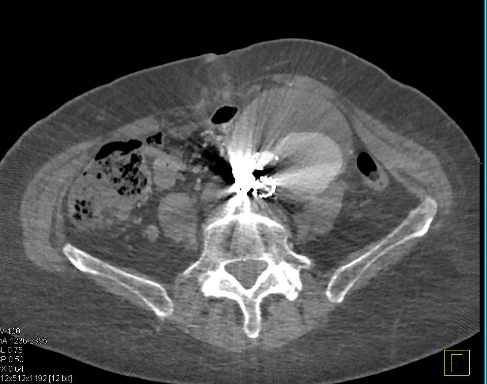 Enlarging Aneurysm with Endoleak - CTisus CT Scan