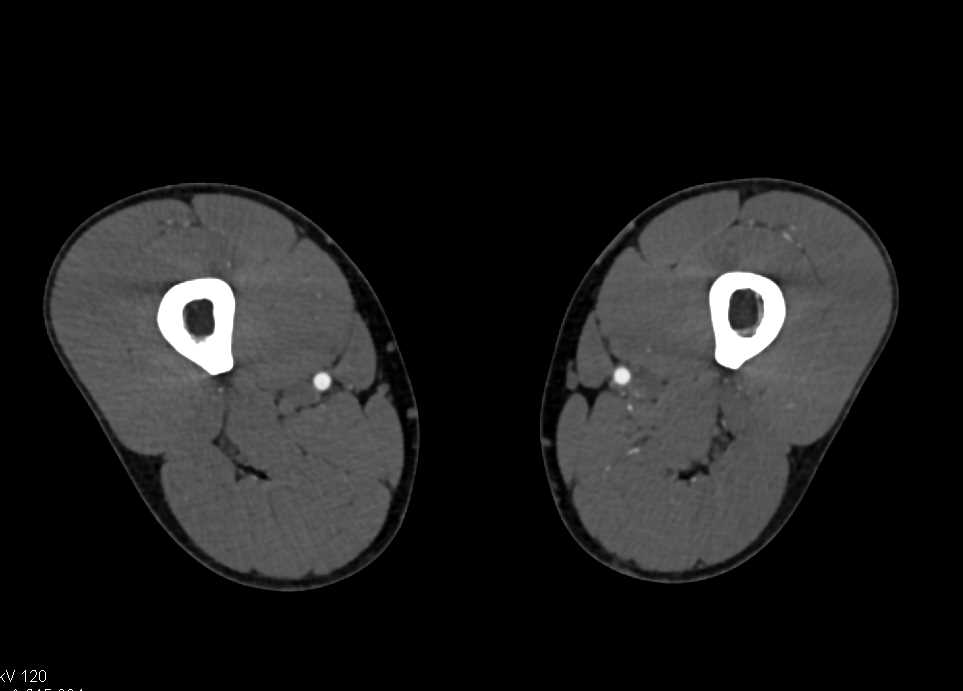 Popliteal Artery Occlusion on the Left - CTisus CT Scan