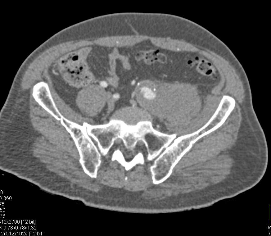 Left Common Iliac Artery Aneurysm with Bleed - CTisus CT Scan