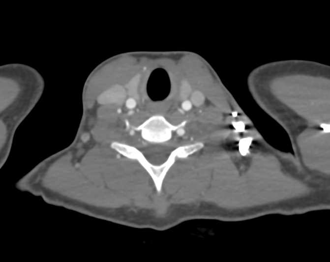 Unusual Vascular Tracking to the  Axillary Artery - CTisus CT Scan