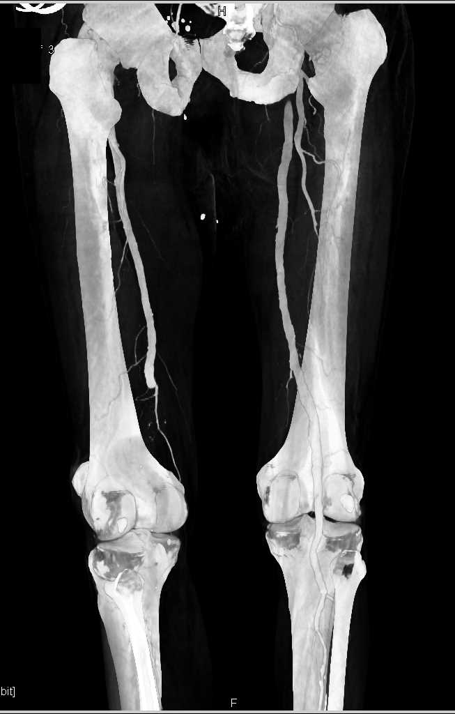 Peripheral Vascular Disease (PVD) with Left Superficial Femoral Artery (SFA) Occlusion - CTisus CT Scan