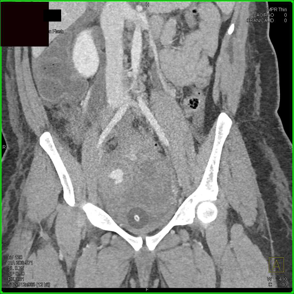 Active Bleed in Pelvis with CTA - CTisus CT Scan