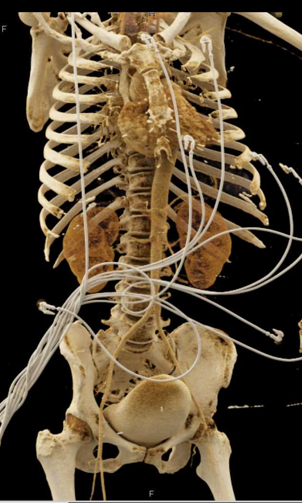 Multiple Arterial Clots on Left Including the Common Iliac Artery - CTisus CT Scan
