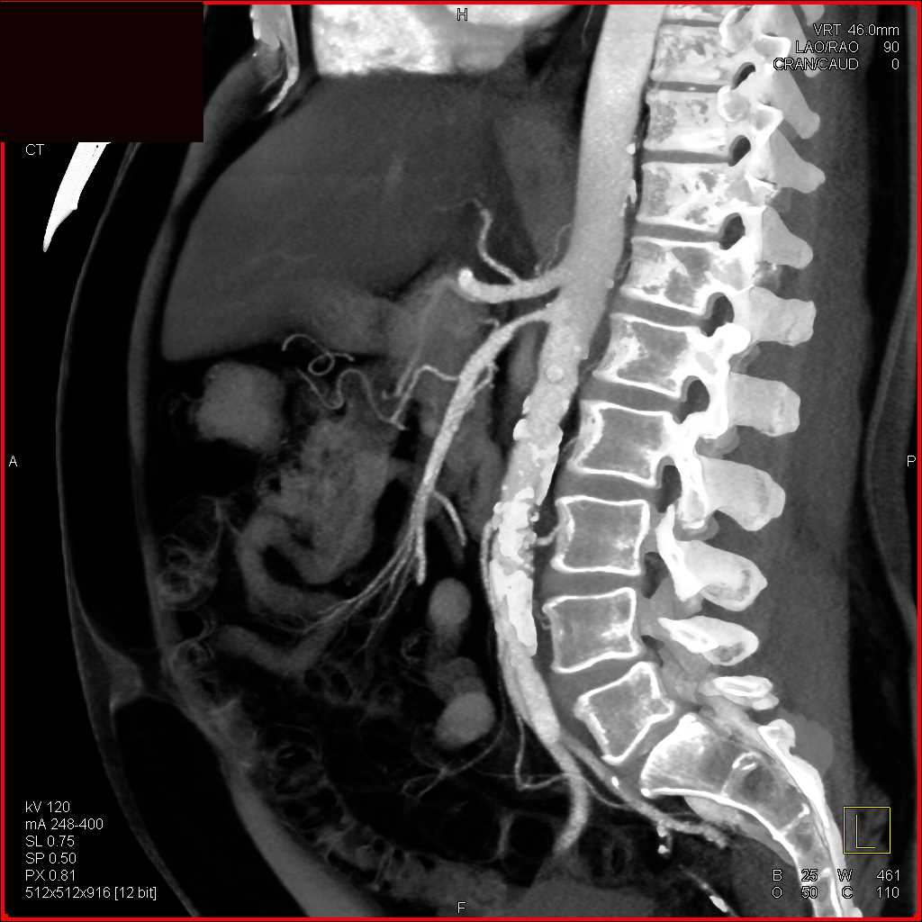 Superior Mesenteric Artery (SMA) Stenosis - CTisus CT Scan