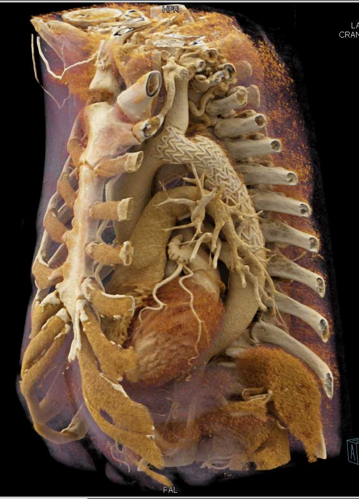 Endovascular Stent Aorta from Coarctation of the Aorta (COA) Repair - CTisus CT Scan