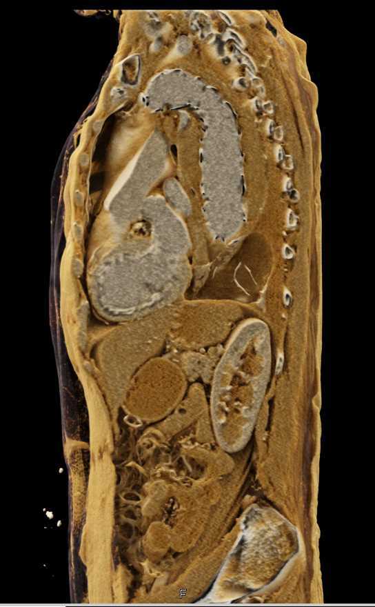 Endovascular Repair Thoracic Aorta - CTisus CT Scan