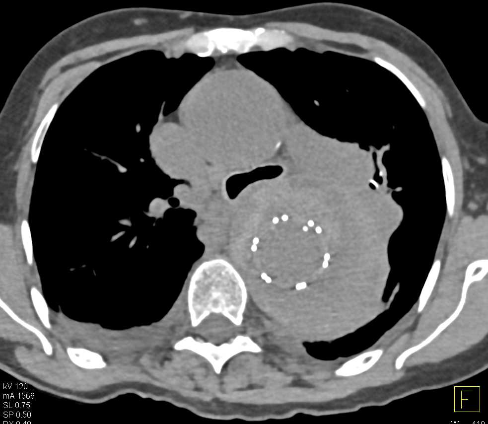 Endovascular Stent Thoracic Aorta - CTisus CT Scan