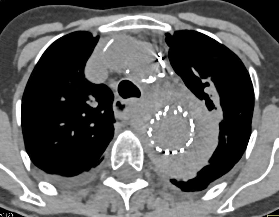 Endovascular Stent Repair with Endoleak - CTisus CT Scan