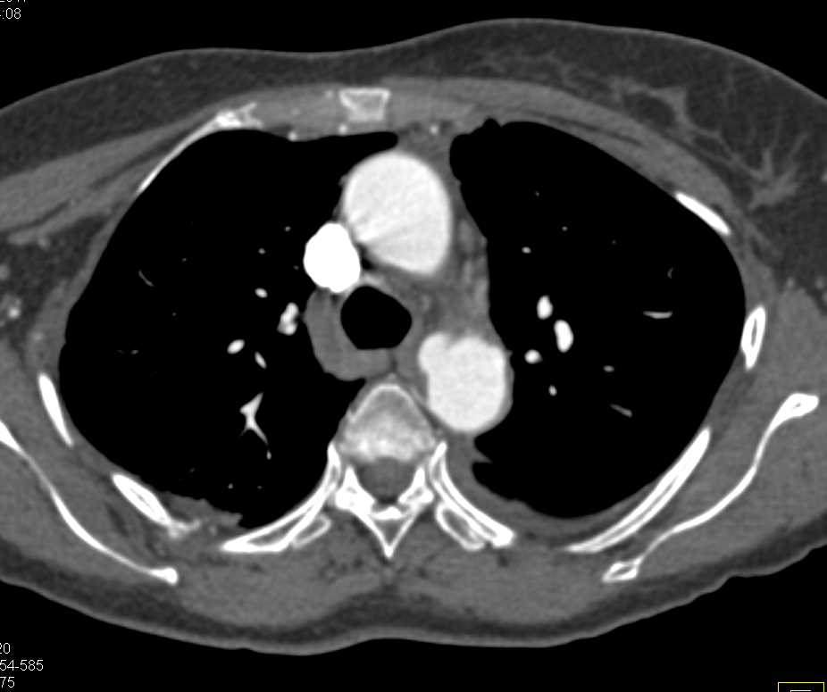 Ulceration at the Ductus Region - CTisus CT Scan